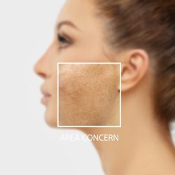 Dark,Spots,,Freckles,hyperpigmentation(melasma,Or,Chloasma),concept-,Skin,Lightening,,Skin,Whitening,,Skin